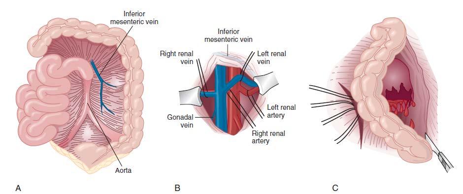 The surgical approach to the renal vessels and kidney.
