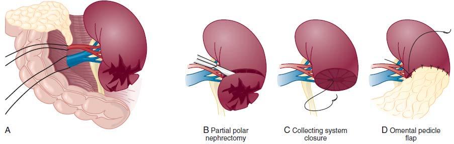 Operative Management Renal Reconstruction Technique for partial nephrectomy: A, total renal exposure; B,