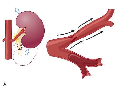 A, Movement of the kidney from blunt trauma (deceleration injury) causes stretch on