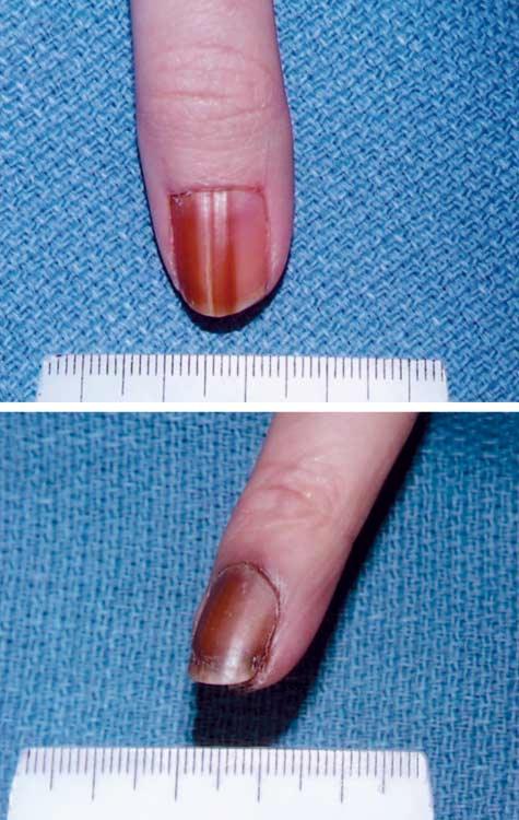 Demographic, Clinical, and Operative Data for 7 Cases of Melanoma In Situ of the Nail Unit Patient No.