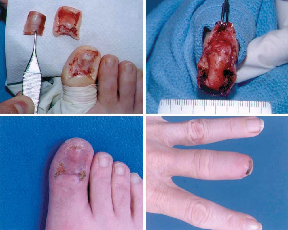 C D Figure 3. Intraoperative (A and ) and 1-month postoperative (C and D) images from case 6 (A and C) and case 2 ( and D) as detailed in the Table. Scale is in millimeters.