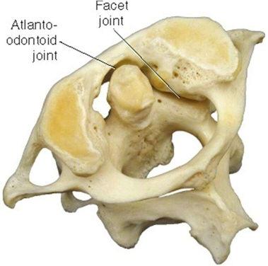 This bump is the odontoid process, often called the dens.