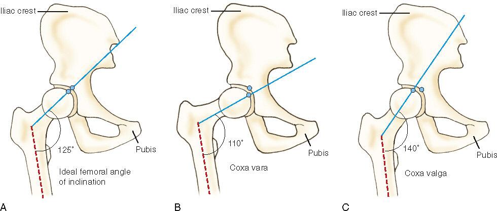 Femoral Angles of Inclination: The head, neck and shaft