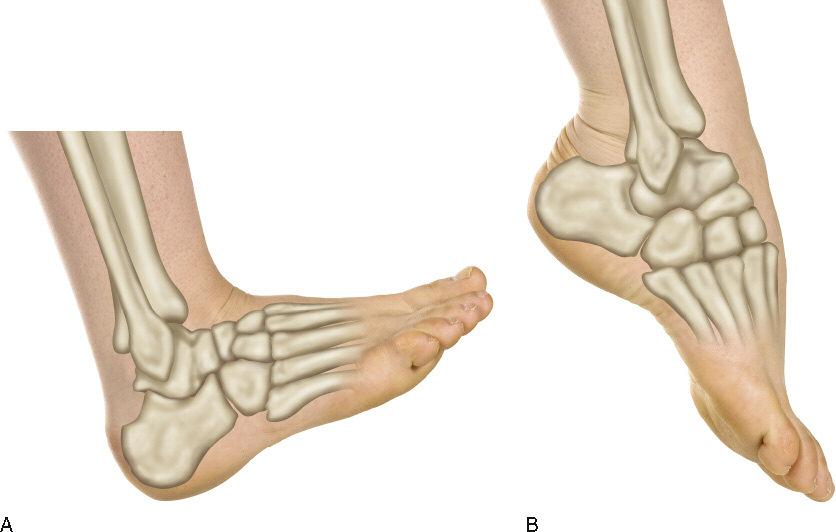 The terms dorsiflexion and plantarflexion are used to avoid confusion regarding which ankle joint motion is flexion and which is extension.