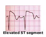 ECG changes: Injury ST segment elevation of greater than 1