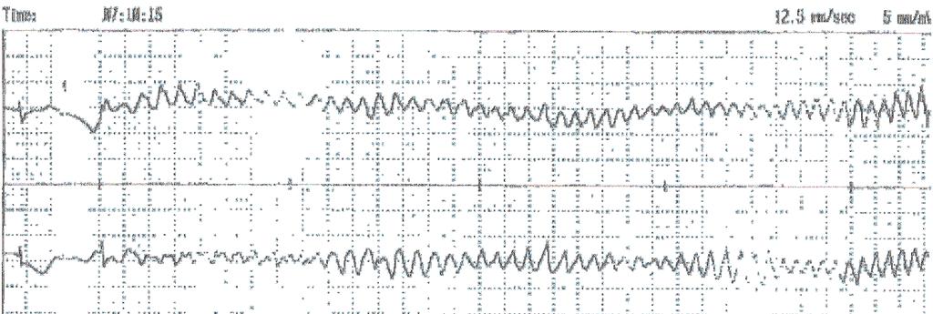 Figure 1. Holter monitor in a 28-year-old woman, with recurrent episodes of loss of consciousness. Figure 2.