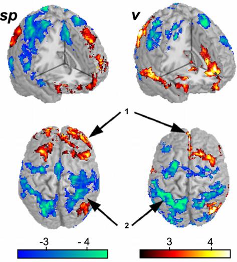 Brain regions activated in the sp all (see Supplementary Table 3) can be grouped in three main clusters, and are reminiscent of the acute pain map in normal subjects (Apkarian et al.
