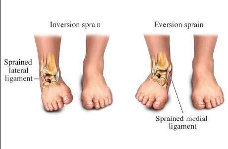 Ankle Sprain Cause: Excessive inversion or eversion of the ankle S/S: Point tenderness, swelling, discoloration, laxity, inability to walk or run properly