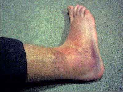 3 rd Degree Ankle Sprain Rupture of ligaments