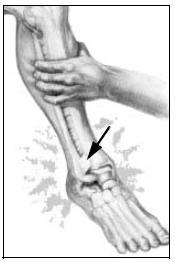 Squeeze Test Compression of the mid tibia and fibula with reproduction of pain in the ankle Indicates High Ankle