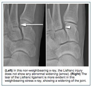 Imaging X-Ray Weight-bearing: AP and lateral, +/- oblique -Tell radiology what diagnosis you are concerned about Lisfranc Injury XR Evaluation: Look for widening of space between 1 st and 2 nd