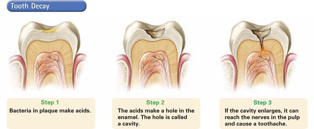 As dentin decays, the cavity