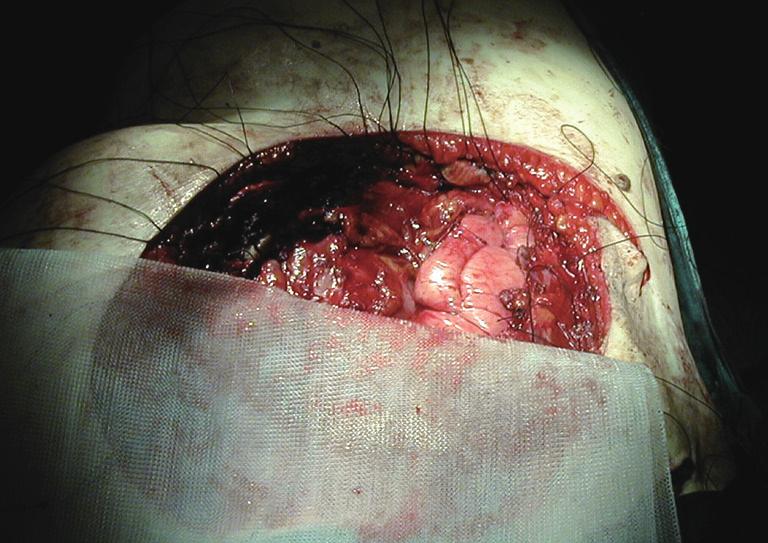 Page 3 of 9 Figure 2 Polipropylene mesh being tailored to cover a chest wall defect with anchoring sutures already in place.