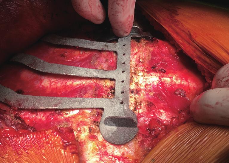 procedure and refinement; (V) Final metal 3D printing of the implant, along with a cutting template (Figure 11), which the surgeon will find invaluable at the time of resection.