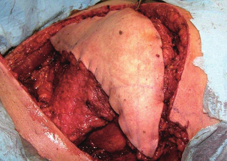sutures allows for a skin patch which is wider than the muscle mass itself. A B Figure 17 Vertical rectus abdominis myocutaneous (VRAM) flap (cadaveric specimen).
