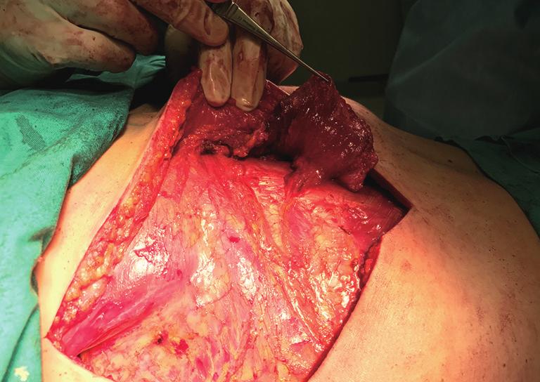 Figure 20 Latissimus dorsi muscle flap prepared for eversion after ligation of the thoracodorsal pedicle and preservation of at least two perforating pedicles.