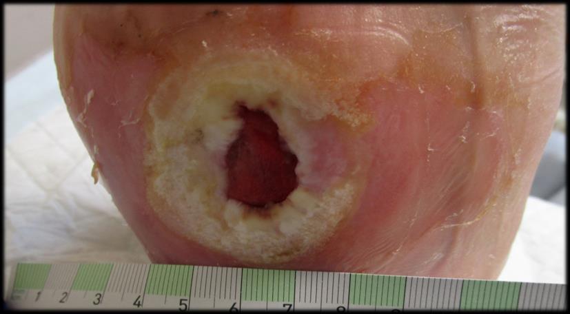 Use of Acellular Fish Skin Biologic cover of the wound that have excessive inflammation, and