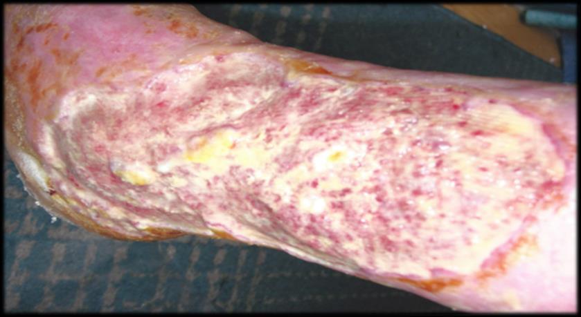 Diabetes Peripheral arterial disease Or by temporary complicating factors: Inflammation or eczema