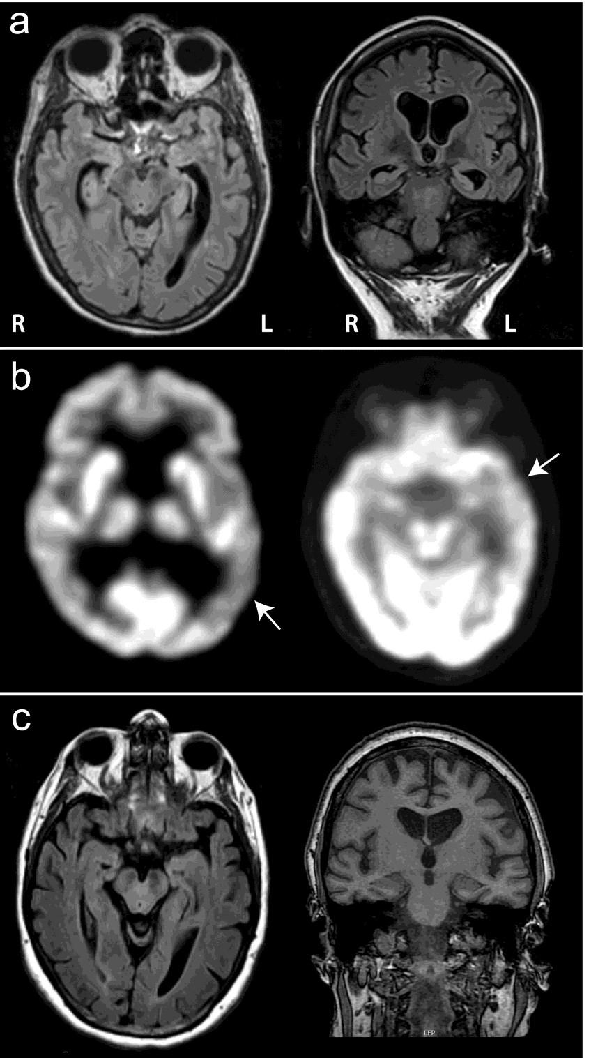Supplementary Figure 1. Neuroimaging findings. (A-B): Patient #1. A. T2-FLAIR weighted MRI, with axial (left) and coronal (right) images demonstrating diffuse atrophy. R = right, L = left. B.