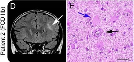 Focal cortical dysplasia (II) may also reflect somatic mutations mtor