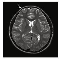 focal epilepsy somatic mutations in mtor (15%); TSC1/2 (12% in mtor