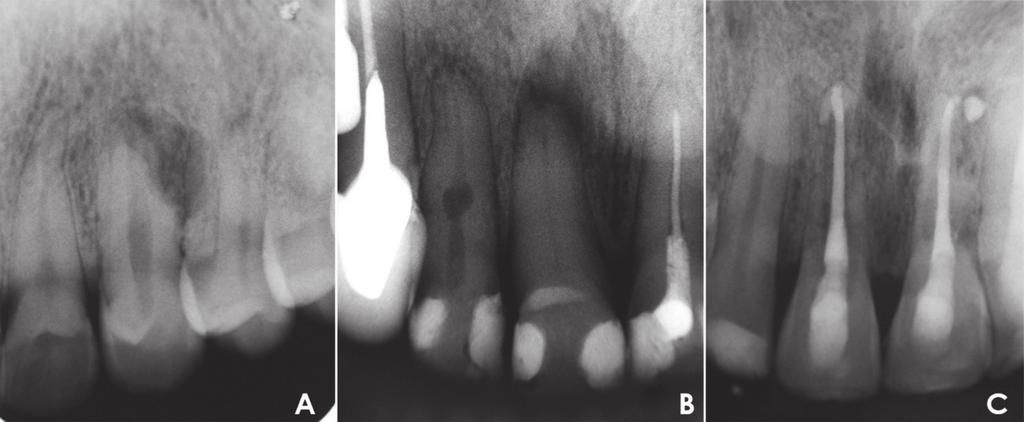 74 Fig. 1 Examples of root resorption evaluated in this study: A. External inflammatory root resorption; B. Internal inflammatory root resorption; C. Replacement resorption.