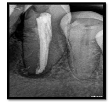 Fig. 8 DISCUSSION Diagnosis of resorption can be complex and often misdiagnosed.