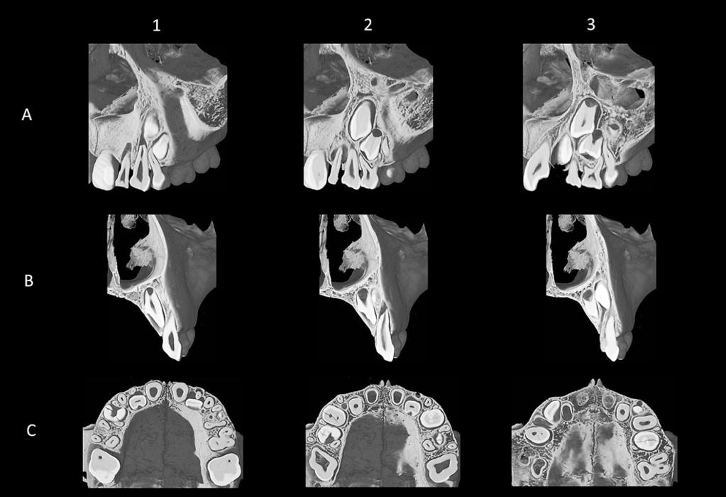 Root resorption of maxillary primary canines 149 Fig.