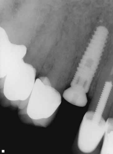 was used as soft tissue augmentation in the buccal of implant