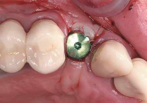 2/13-mm implant was placed in area of tooth No.