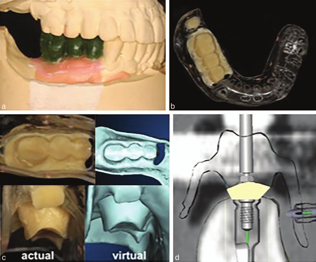 Papilla Formation, Guided Implant Surgery, and Immediate Restoration FIGURE 1. (a) Prosthesis waxup radiographic guide (b) was made from the waxup.