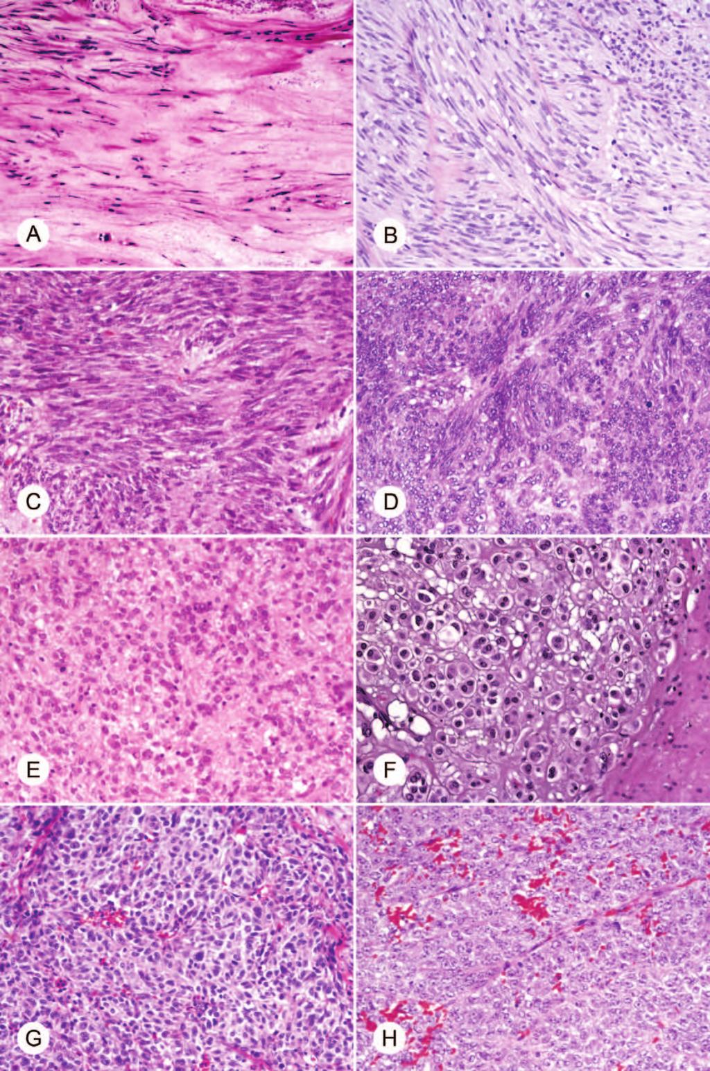Figure 2. Histologic spectrum of gastric gastrointestinal stromal tumor (GIST). A, Sclerosing spindle cell GIST. B, Palisaded-vacuolated spindle cell GIST. C, Hypercellular spindle cell GIST.
