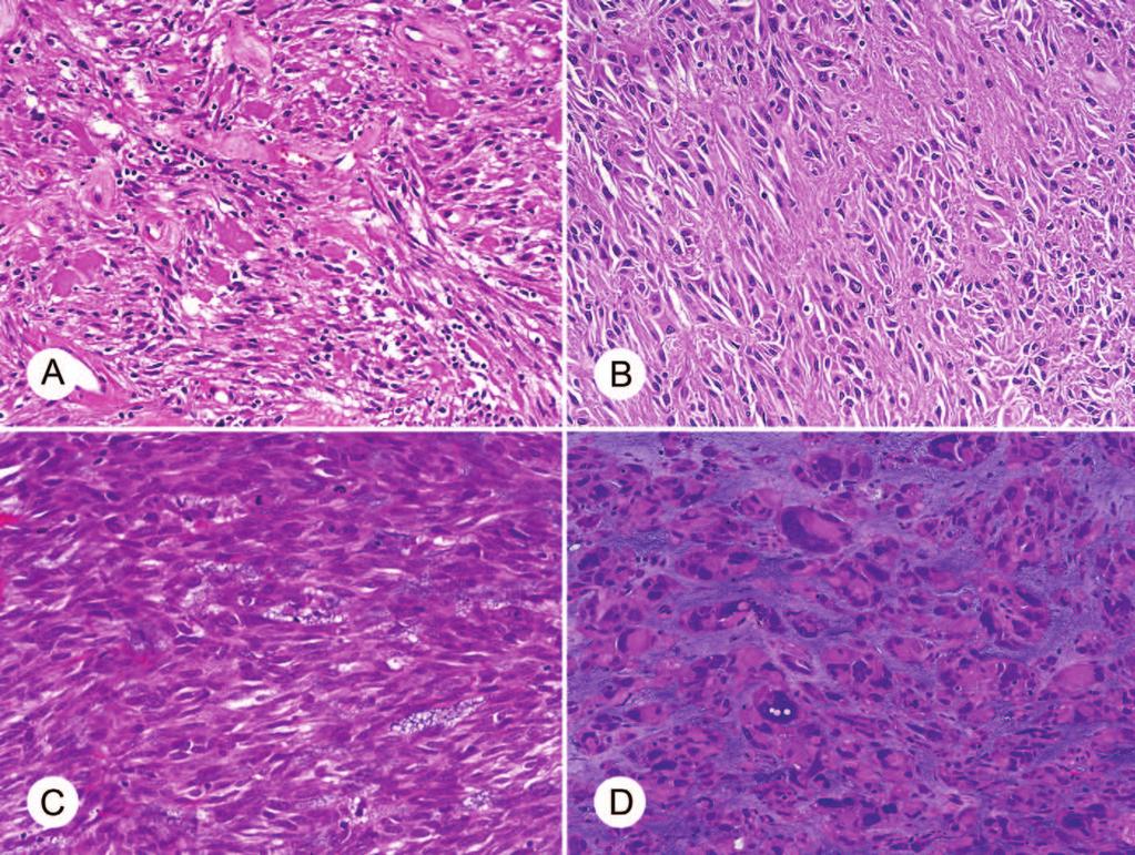 Figure 3. Histologic spectrum of small intestinal gastrointestinal stromal tumor (GIST). A, Example rich in skeinoid fibers. B, Tumor with abundant pools of cell processes.