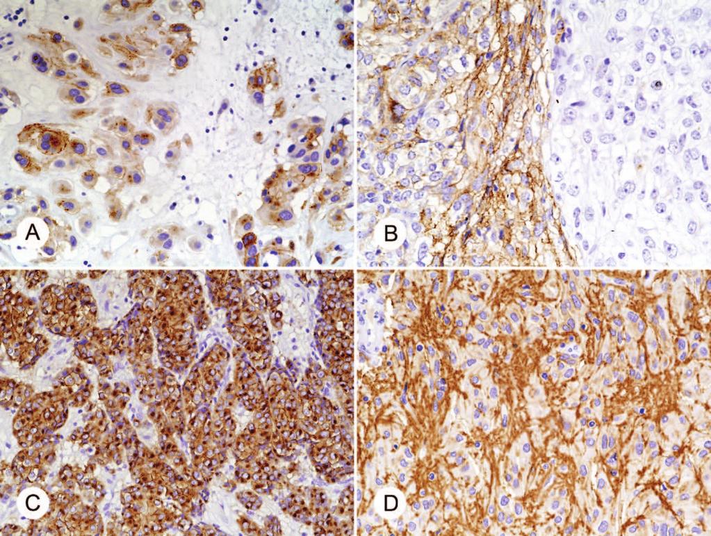 Figure 4. Examples of Kit positivity in gastrointestinal stromal tumor (GIST). A, Relatively weak and patchy positivity in gastric epithelioid GIST. B, Tumor with Kit positive and negative areas.