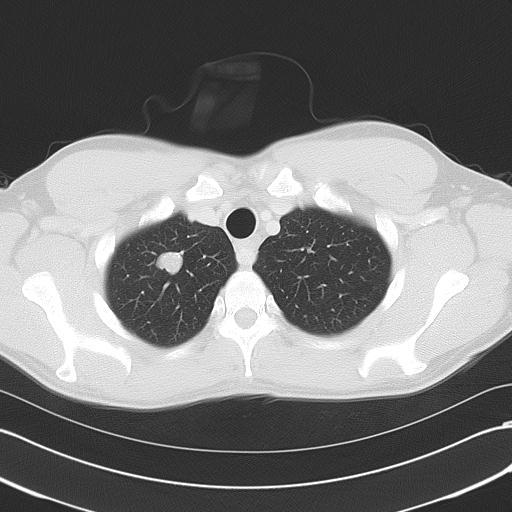 GIST, pulmonary chondromas, and paraganglioma that can be malignant