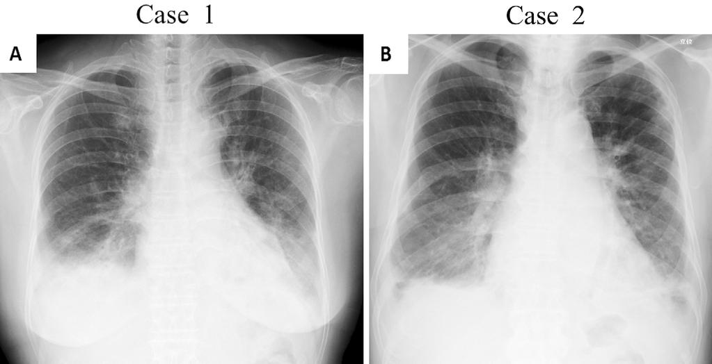 Intern Med 51: 3405-3410, 2012 Figure 2. Chest radiographs.