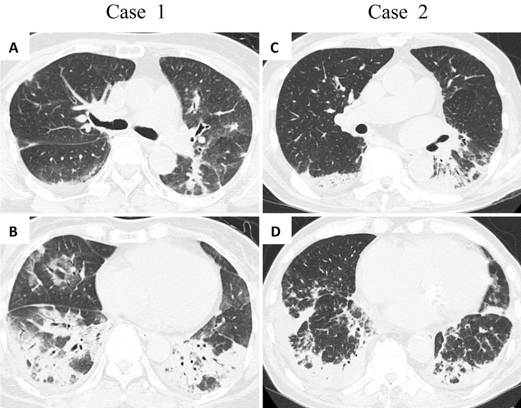lobes. Figure 3. High-resolution chest CT scans.