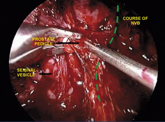 Bladder-neck incision The apex is pulled ventrally by applying traction on the catheter.