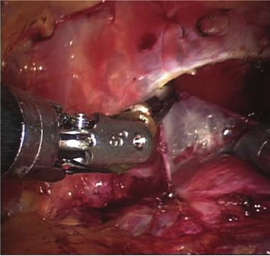 2 ISRN Urology apex is then incised and the urethra is exposed and cut.
