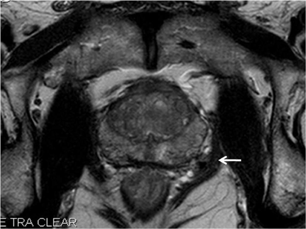 Fig. 3: Fig 2-A. A 68-year-old man with stage T2b prostate malignancy (PSA; 8.5 ng/ dl, Gleason score; 7).