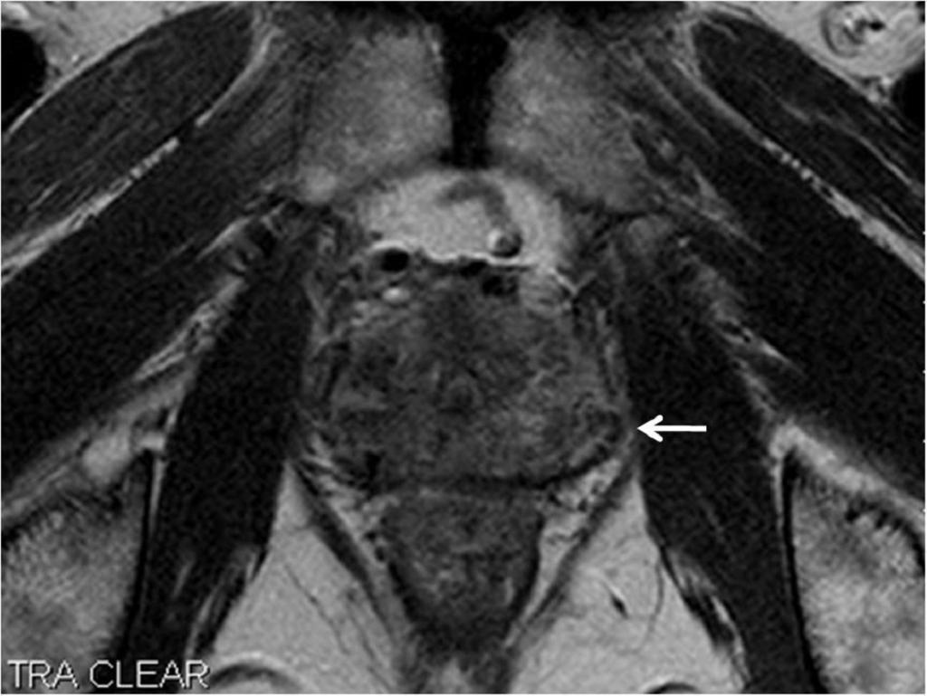 Fig. 5: Fig 3-A. A 68-year-old man with stage T2c prostate malignancy (PSA; 10.2 ng/dl, Gleason score; 7).