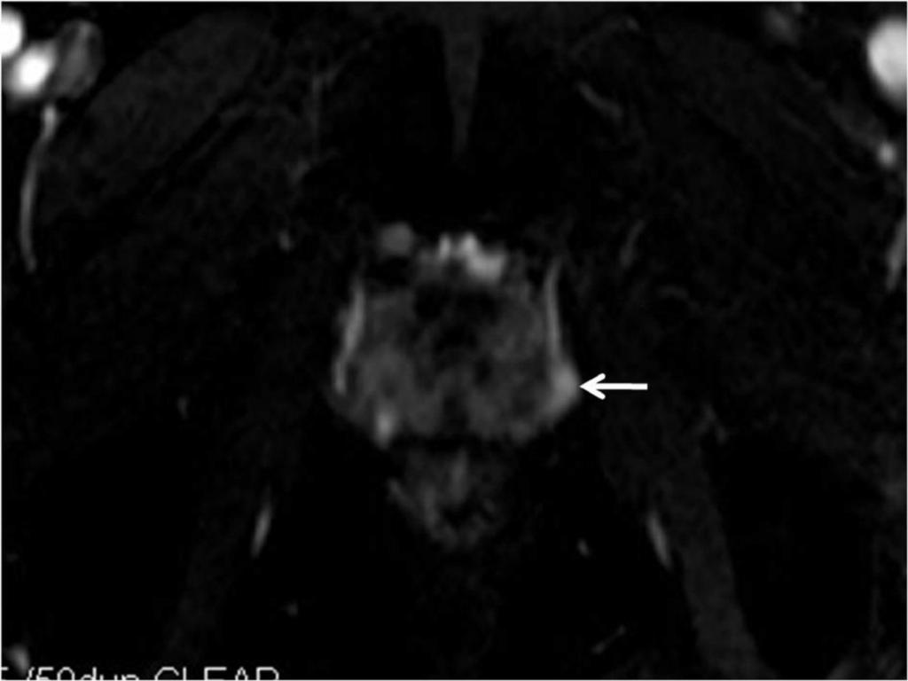 Fig. 6: Fig 3-B. T2 - weighted image with additional DCE - MRI shows a strong enhancing vascular structure with clear observation in the left rectolateral region (arrow).