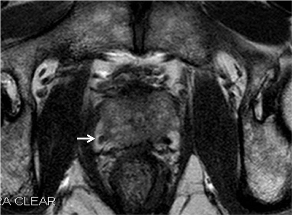 Fig. 1: Fig 1-A. A 65-year-old man with stage T2a prostate malignancy (PSA; 5.1 ng/dl, Gleason score; 6).