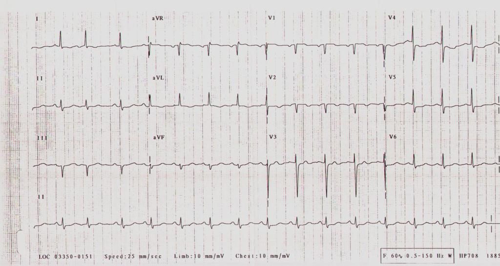 Case based risk stratification 8 year old female presents with 45 minutes of chest heaviness that resolved with