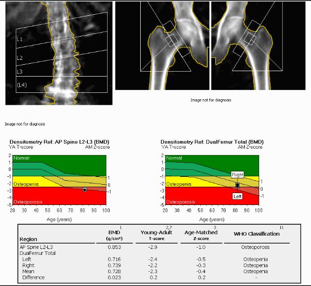 Case DEXA scan Mar 2017 Mean L spine T-score of -2.