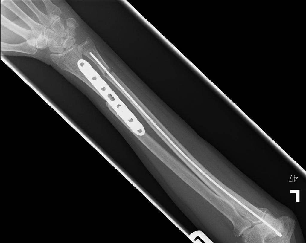 X-ray Left Wrist 7