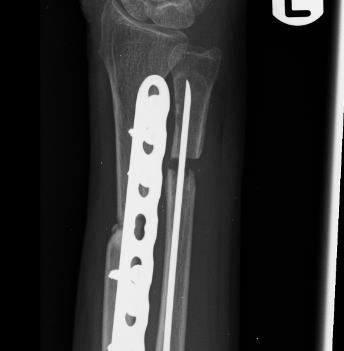 X-ray Left Wrist 6 months