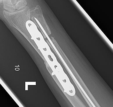 X-ray Left Wrist 4 months
