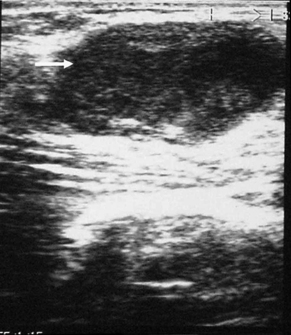 Ulnar nerve abscess 383 Figure 1. Ultrasound examination of the left arm showing a well-defined, cystic lesion with internal debris ( " ).