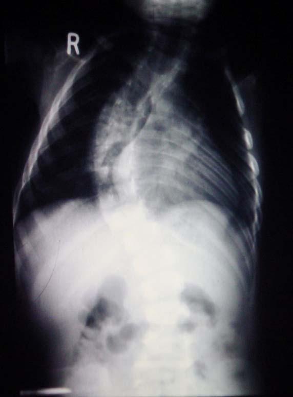 Scoliotic thorax Fannel